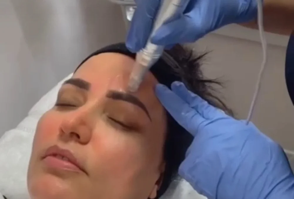 Woman receiving a microneedling treatment on her face